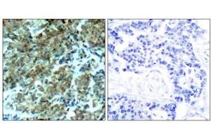 Immunohistochemical analysis of paraffin-embedded human breast carcinoma tissue, using Cortactin (Ab-466) antibody (E021264). (Cortactin Antikörper)