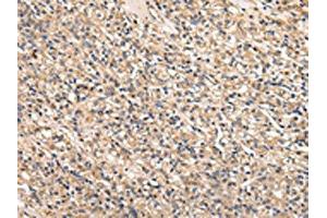 The image on the left is immunohistochemistry of paraffin-embedded Human prostate cancer tissue using ABIN7128011(SERPINA7 Antibody) at dilution 1/25, on the right is treated with fusion protein. (SERPINA7 Antikörper)