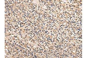 The image on the left is immunohistochemistry of paraffin-embedded Human prostate cancer tissue using ABIN7128011(SERPINA7 Antibody) at dilution 1/25, on the right is treated with fusion protein. (SERPINA7 Antikörper)