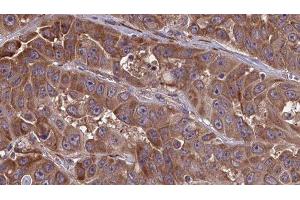 ABIN6277662 at 1/100 staining Human liver cancer tissue by IHC-P. (LSP1 Antikörper  (C-Term))
