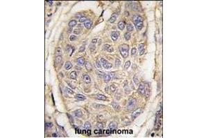 Formalin-fixed and paraffin-embedded human lung carcinoma tissue reacted with B2M antibody (C-term) (ABIN389259 and ABIN2839397) , which was peroxidase-conjugated to the secondary antibody, followed by DAB staining. (beta-2 Microglobulin Antikörper  (C-Term))