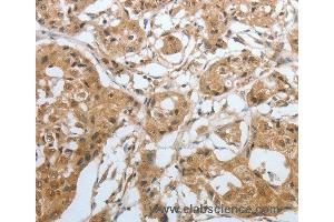 Immunohistochemistry of Human lung cancer using AMPH Polyclonal Antibody at dilution of 1:30 (Amphiphysin Antikörper)