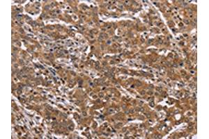 The image on the left is immunohistochemistry of paraffin-embedded Human liver cancer tissue using ABIN7129424(FAAH2 Antibody) at dilution 1/30, on the right is treated with fusion protein. (FAAH2 Antikörper)