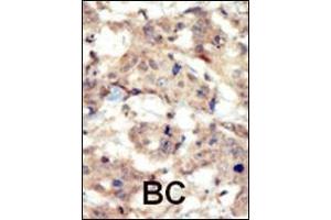 Formalin-fixed and paraffin-embedded human cancer tissue reacted with the primary antibody, which was peroxidase-conjugated to the secondary antibody, followed by DAB staining. (EPH Receptor B6 Antikörper  (N-Term))