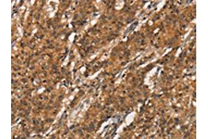 The image on the left is immunohistochemistry of paraffin-embedded Human gastric cancer tissue using ABIN7189855(APOC4 Antibody) at dilution 1/20, on the right is treated with synthetic peptide. (APOC4 Antikörper)