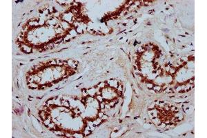 IHC image of ABIN7173536 diluted at 1:400 and staining in paraffin-embedded human breast cancer performed on a Leica BondTM system. (TSEN15 Antikörper  (AA 1-171))