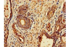 Immunohistochemistry of paraffin-embedded human prostate cancer using ABIN7153175 at dilution of 1:100 (FZD1 Antikörper  (AA 73-322))