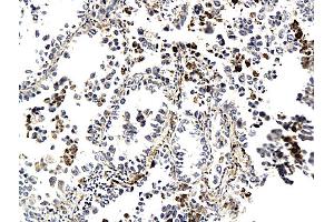 Formalin-fixed and paraffin embedded human lung cancer labeled with Anti-CK7 (Human) Polyclonal Antibody, Unconjugated (ABIN732023) followed by conjugation to the secondary antibody and DAB staining (Cytokeratin 7 Antikörper  (AA 251-350))