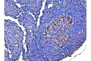 IHC analysis of Survivin using anti-Survivin antibody (ABIN3043511).