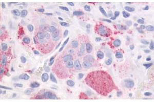 Anti-PTHR / PTHR1 antibody IHC staining of human bone, giant cell tumor. (PTH1R Antikörper  (Internal Region))
