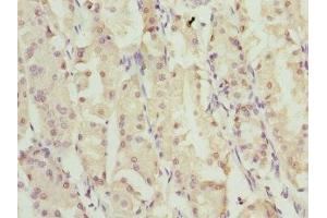 Immunohistochemistry of paraffin-embedded human gastric cancer using ABIN7176368 at dilution of 1:100 (ZNF549 Antikörper  (AA 1-280))