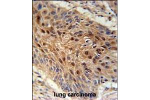 C4orf31 Antibody immunohistochemistry analysis in formalin fixed and paraffin embedded human lung carcinoma followed by peroxidase conjugation of the secondary antibody and DAB staining. (NDNF Antikörper  (N-Term))