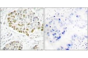 Immunohistochemistry analysis of paraffin-embedded human lung carcinoma tissue, using STAT5A (Ab-725) Antibody. (STAT5A Antikörper  (AA 696-745))