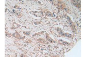 IHC-P analysis of Human Breast Cancer Tissue, with DAB staining. (AKT3 Antikörper  (AA 46-338))