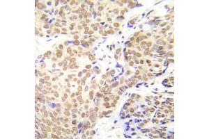 Immunohistochemical analysis of paraffin-embedded human lung adenocarcinoma tissue using HDAC1 (Phospho-Ser421/423) Antibody (E012085).