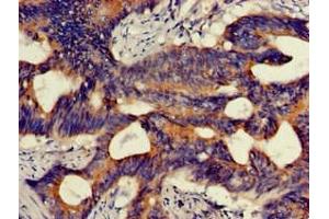 Immunohistochemistry of paraffin-embedded human colon cancer using ABIN7163904 at dilution of 1:100 (HMBS Antikörper  (AA 283-330))