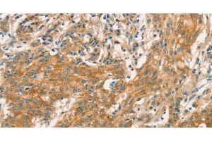 Immunohistochemistry of paraffin-embedded Human gastric cancer tissue using CPA2 Polyclonal Antibody at dilution 1:40 (Carboxypeptidase A2 Antikörper)