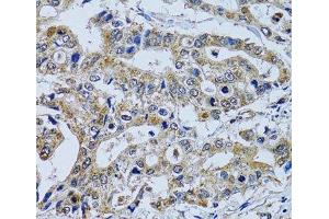 Immunohistochemistry of paraffin-embedded Human colon carcinoma using TPPP3 Polyclonal Antibody at dilution of 1:100 (40x lens). (TPPP3 Antikörper)