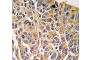 Immunohistochemistry analysis in human lung carcinoma tissue (Formalin-fixed, Paraffin-embedded) using RIPK3 / RIP3  Antibody (N-term), followed by peroxidase-conjugated secondary antibody and DAB staining. (RIPK3 Antikörper  (N-Term))