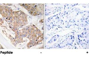 Immunohistochemical analysis of paraffin-embedded human breast carcinoma tissue using IL13RA1 polyclonal antibody . (IL13 Receptor alpha 1 Antikörper)