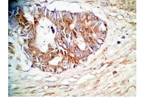 Human stomach cancer tissue was stained by rabbit Anti-Spexin prepro (36-58)  (H) Antiserum (Spexin Antikörper  (Preproprotein))
