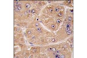 Formalin-fixed and paraffin-embedded human hepatocarcinoma tissue reacted with FUCA2 antibody (N-term) (Cat#AP14356PU-N), which was peroxidase-conjugated to the secondary antibody, followed by DAB staining. (FUCA2 Antikörper  (N-Term))