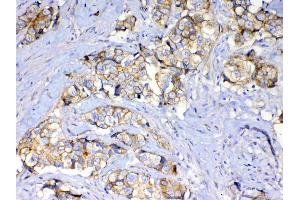 IHC analysis of beta Catenin using anti-beta Catenin antibody . (CTNNB1 Antikörper  (AA 2-233))