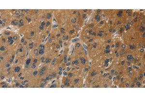 Immunohistochemistry of paraffin-embedded Human liver cancer tissue using DUSP23 Polyclonal Antibody at dilution 1:30 (DUSP23 Antikörper)