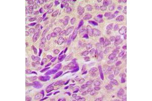 Immunohistochemical analysis of RAB41 staining in human breast cancer formalin fixed paraffin embedded tissue section.