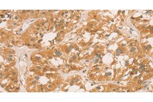 Immunohistochemistry of paraffin-embedded Human thyroid cancer tissue using CPB1 Polyclonal Antibody at dilution of 1:60 (CPB1 Antikörper)