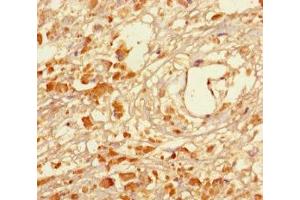 Immunohistochemistry of paraffin-embedded human melanoma using ABIN7159268 at dilution of 1:100 (MAGEA5 Antikörper  (AA 1-124))