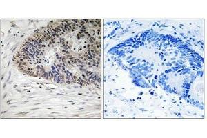 Immunohistochemistry analysis of paraffin-embedded human colon carcinoma tissue using MDM4 (Phospho-Ser367) antibody. (MDM4-binding Protein Antikörper  (pSer367))
