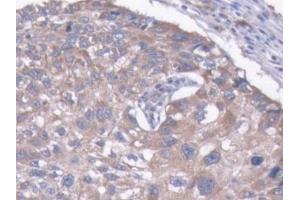 DAB staining on IHC-P; Samples: Human Liver cancer Tissue (MAP1B Antikörper  (AA 2207-2468))