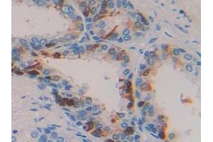 Detection of TGFa in Human Prostate Tissue using Polyclonal Antibody to Transforming Growth Factor Alpha (TGFa) (TGFA Antikörper  (AA 24-98))