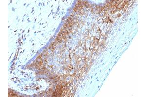 Formalin-fixed, paraffin-embedded human Cervical Ca stained with Beta-2-Microglobulin Mouse Monoclonal Antibody (B2M/1118) (beta-2 Microglobulin Antikörper)