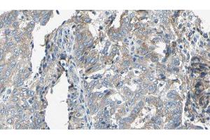 ABIN6276761 at 1/100 staining Human cervical cancer tissue by IHC-P. (TAP2 Antikörper  (Internal Region))