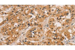 Immunohistochemistry of paraffin-embedded Human thyroid cancer tissue using CTNNBIP1 Polyclonal Antibody at dilution 1:30 (CTNNBIP1 Antikörper)