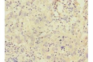 Immunohistochemistry of paraffin-embedded human liver cancer using ABIN7146291 at dilution of 1:100 (Calcitonin Receptor Antikörper  (AA 25-148))