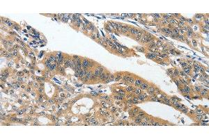 Immunohistochemistry of paraffin-embedded Human gasrtic cancer tissue using ANKZF1 Polyclonal Antibody at dilution 1:40 (ANKZF1 Antikörper)