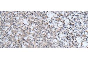 Immunohistochemistry of paraffin-embedded Human tonsil tissue using ABCA6 Polyclonal Antibody at dilution of 1:40(x200) (ABCA6 Antikörper)