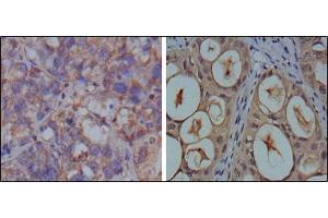 Immunohistochemical analysis of paraffin-embedded human breast carcinoma (left) and kidney carcinoma (right), showing cytoplasmic localization using GAPDH antibody with DAB staining. (GAPDH Antikörper)