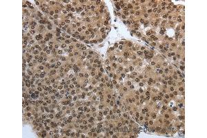 Immunohistochemistry of Human thyroid cancer using SMAD7 Polyclonal Antibody at dilution of 1:40 (SMAD7 Antikörper)