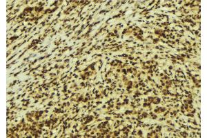 ABIN6274149 at 1/100 staining Human breast cancer tissue by IHC-P.
