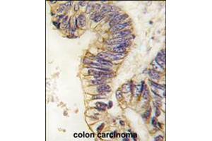 Formalin-fixed and paraffin-embedded human colon carcinoma tissue reacted with SRC1 antibody , which was peroxidase-conjugated to the secondary antibody, followed by DAB staining. (NCOA1 Antikörper  (C-Term))
