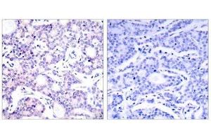 Immunohistochemical analysis of paraffin-embedded human breast carcinoma tissue using NF-κB p105/p50 (Ab-893) antibody (E021018). (NFKB1 Antikörper)