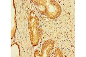Immunohistochemistry of paraffin-embedded human prostate cancer using ABIN7156421 at dilution of 1:100 (INTS9 Antikörper  (AA 368-658))