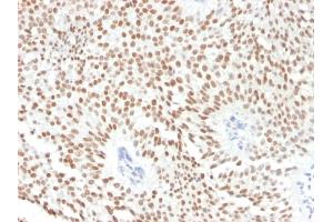 Formalin-fixed, paraffin-embedded human Bladder Carcinoma stained with FOXA1 Monoclonal Antibody (FOXA1/1241).