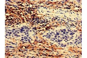 Immunohistochemistry analysis of human bladder cancer using ABIN7171814 at dilution of 1:100 (TEX43 Antikörper  (AA 1-134))