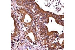 RIPK1 antibody immunohistochemistry analysis in formalin fixed and paraffin embedded human prostate carcinoma. (RIPK1 Antikörper  (AA 152-180))