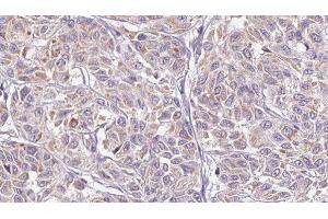 ABIN6278898 at 1/100 staining Human Melanoma tissue by IHC-P. (IL28B Antikörper)